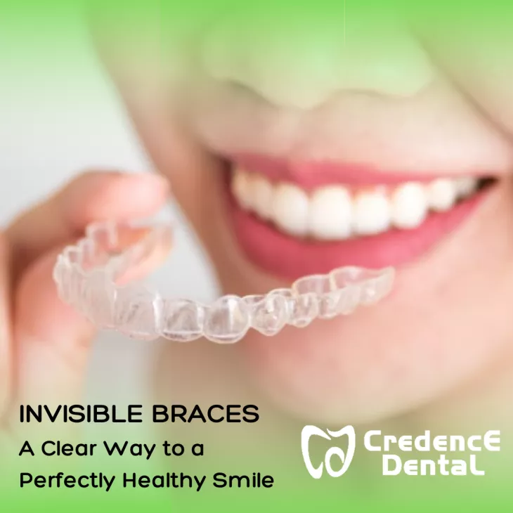 Invisible braces specialist in bangalore 