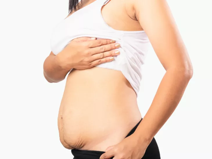 Tummy tuck after pregnancy